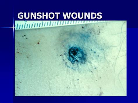 Gunshot Wounds Forensic Pathology .